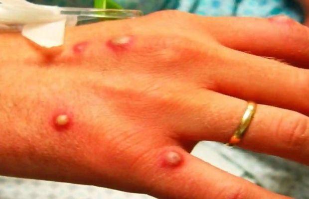 Edo confirms eight cases of monkeypox