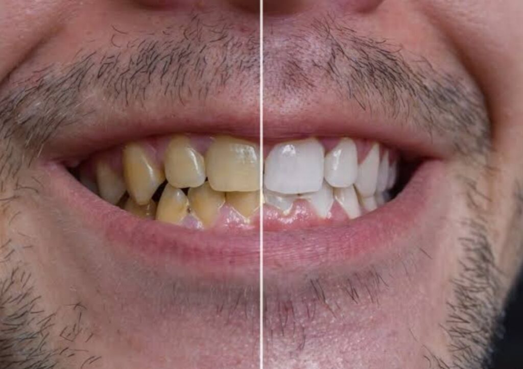 How to Naturally Remove Yellow Stains from Your Teeth Permanently 
